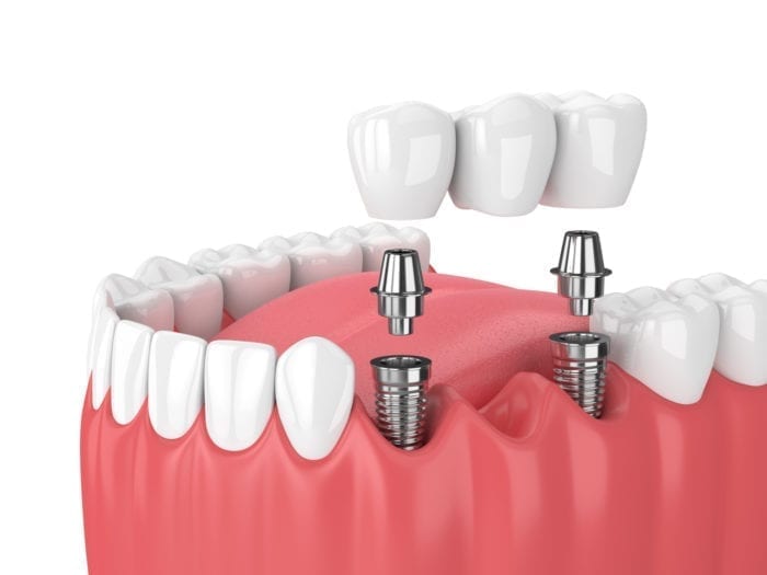 dental implant clinic in bhubaneswar