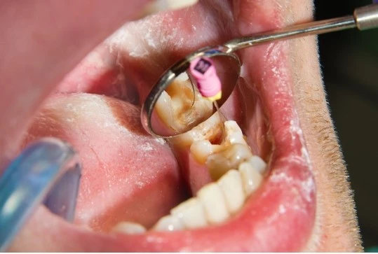 Root-Canal-Treatment-Bhubaneswar