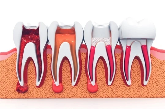 Root-Canal-Treatment