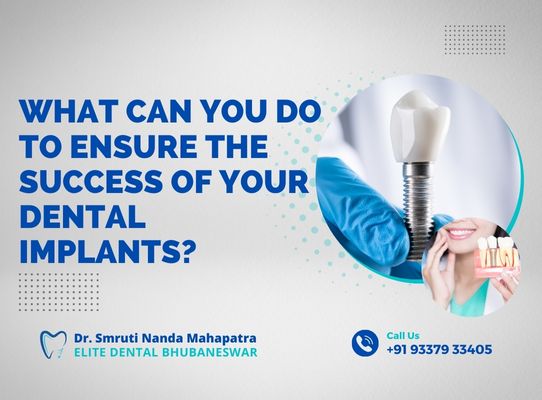 What Can You Do to Ensure the Success of Your Dental Implants