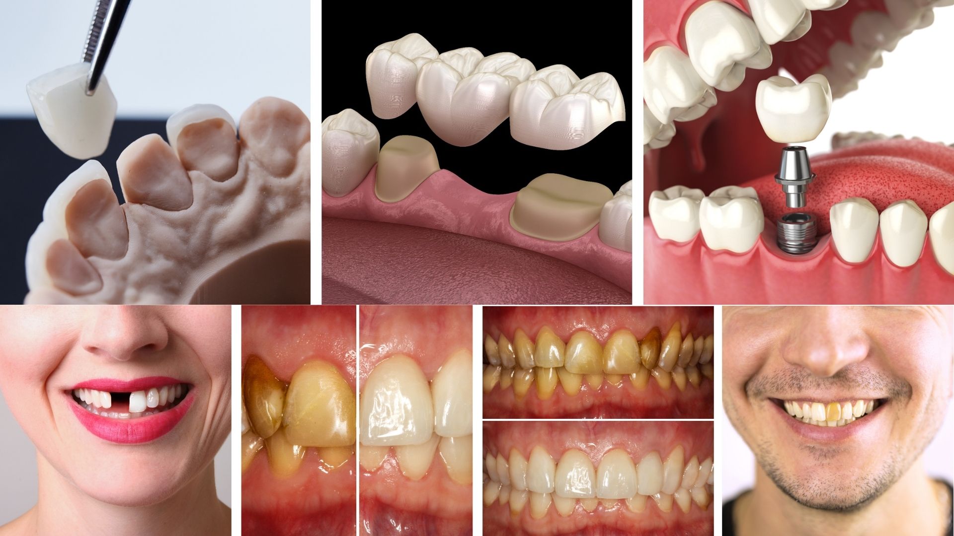 Restorative Dentistry in Bhubaneswar