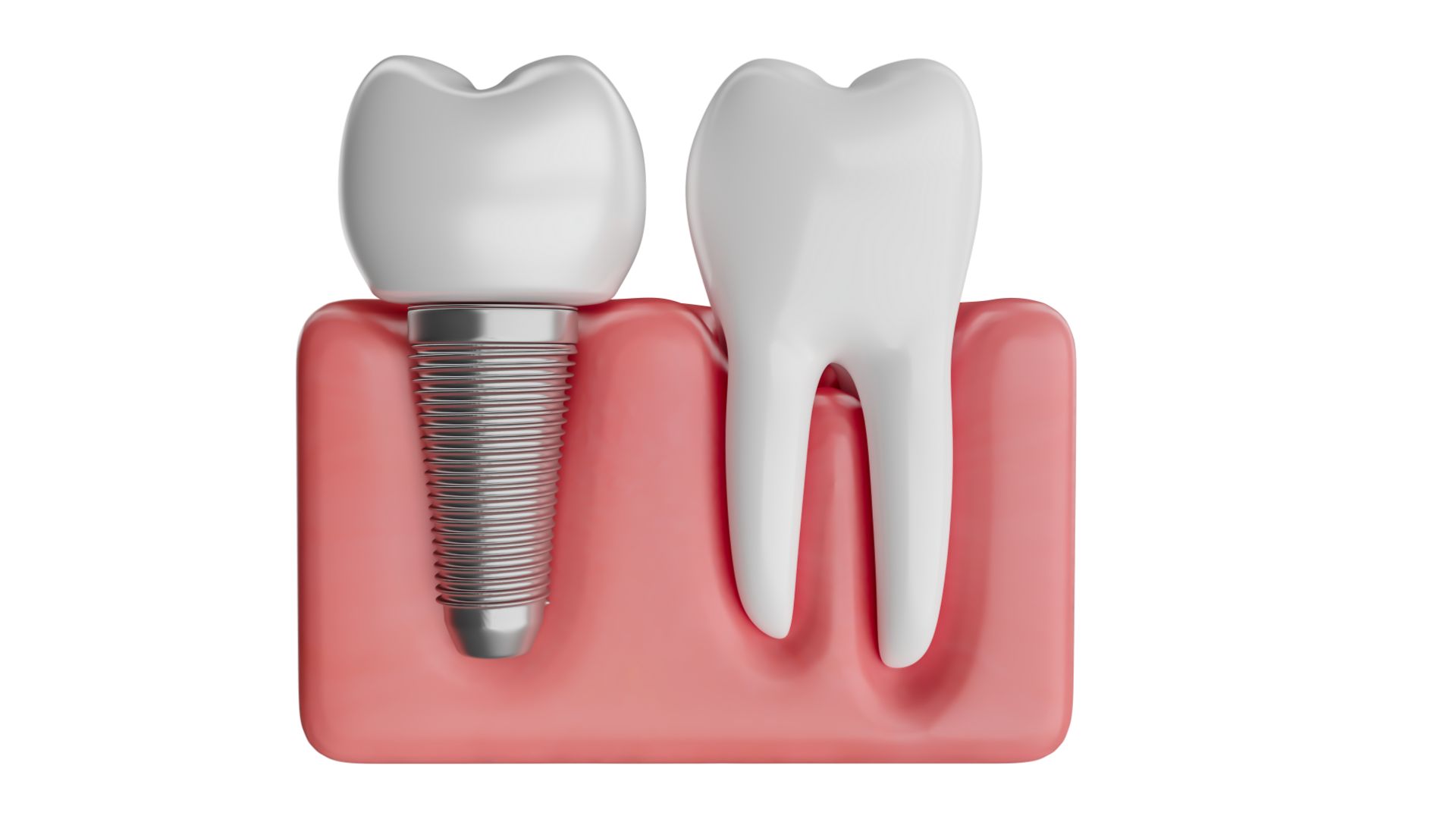 Dental Implants