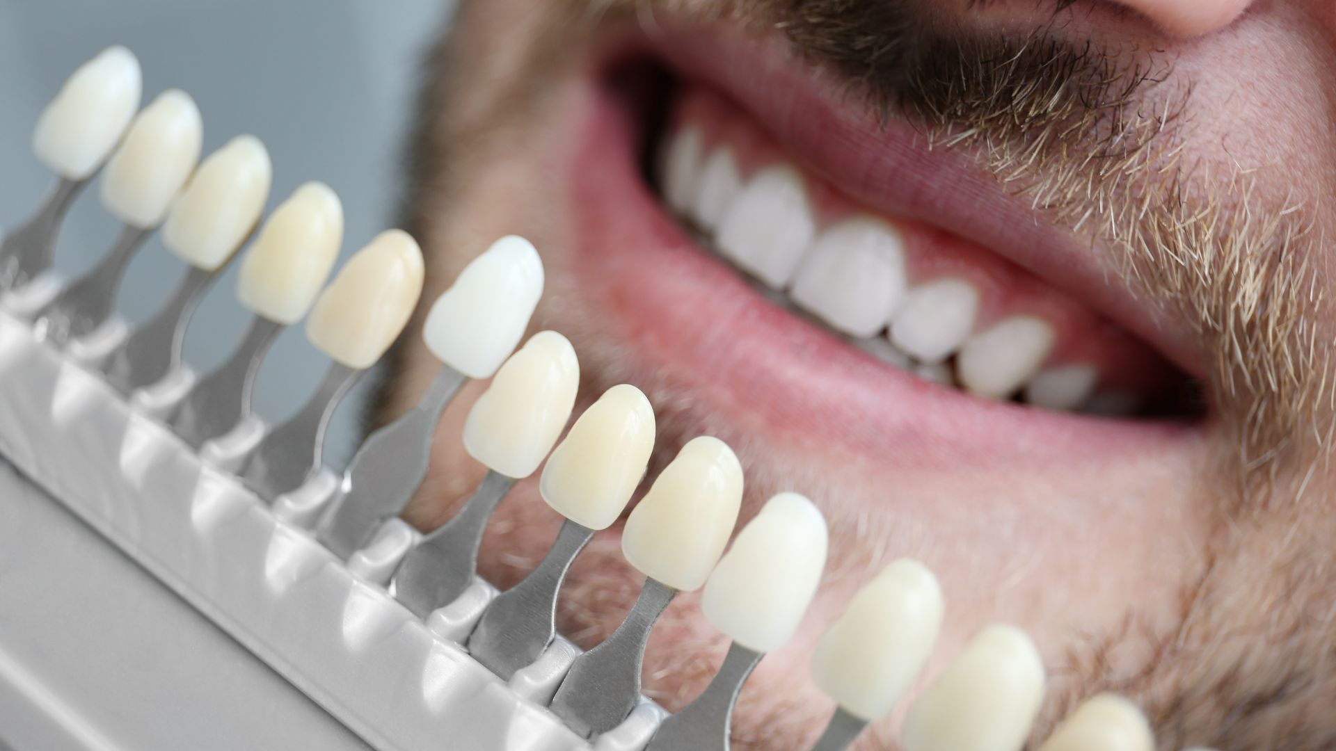 Porcelain Veneers