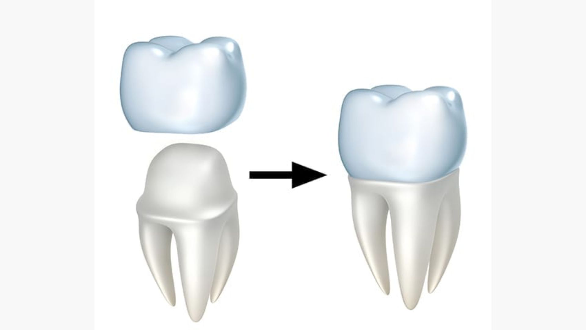 Dental Crowns