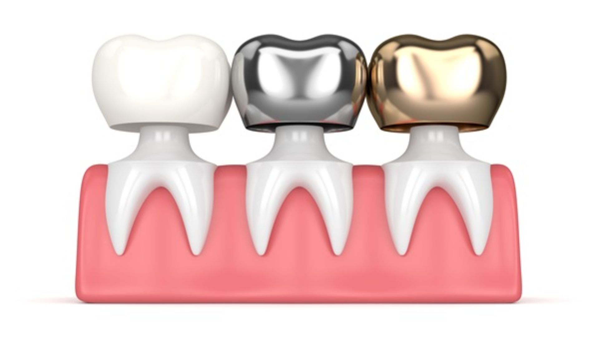 Dental_Crowns_Services_EliteDental