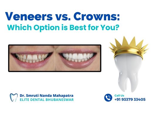 Veneers or Crowns Which Option is Best for You