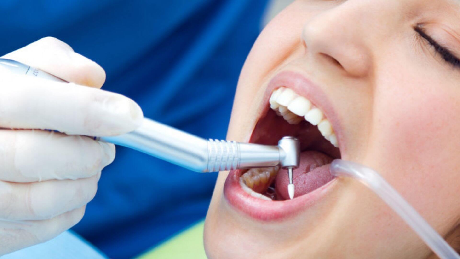 Safe & Effective Tooth Filling in Bhubaneswar