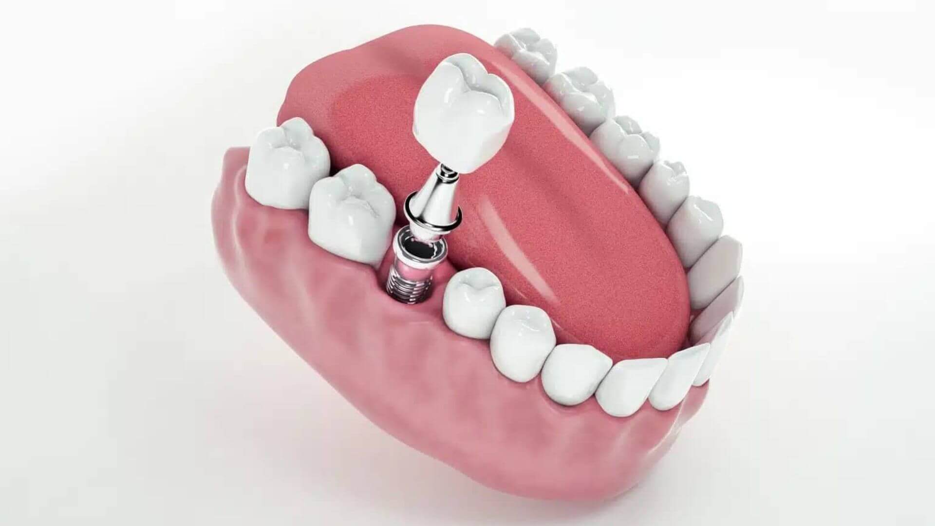 Care for Dentures and Implants