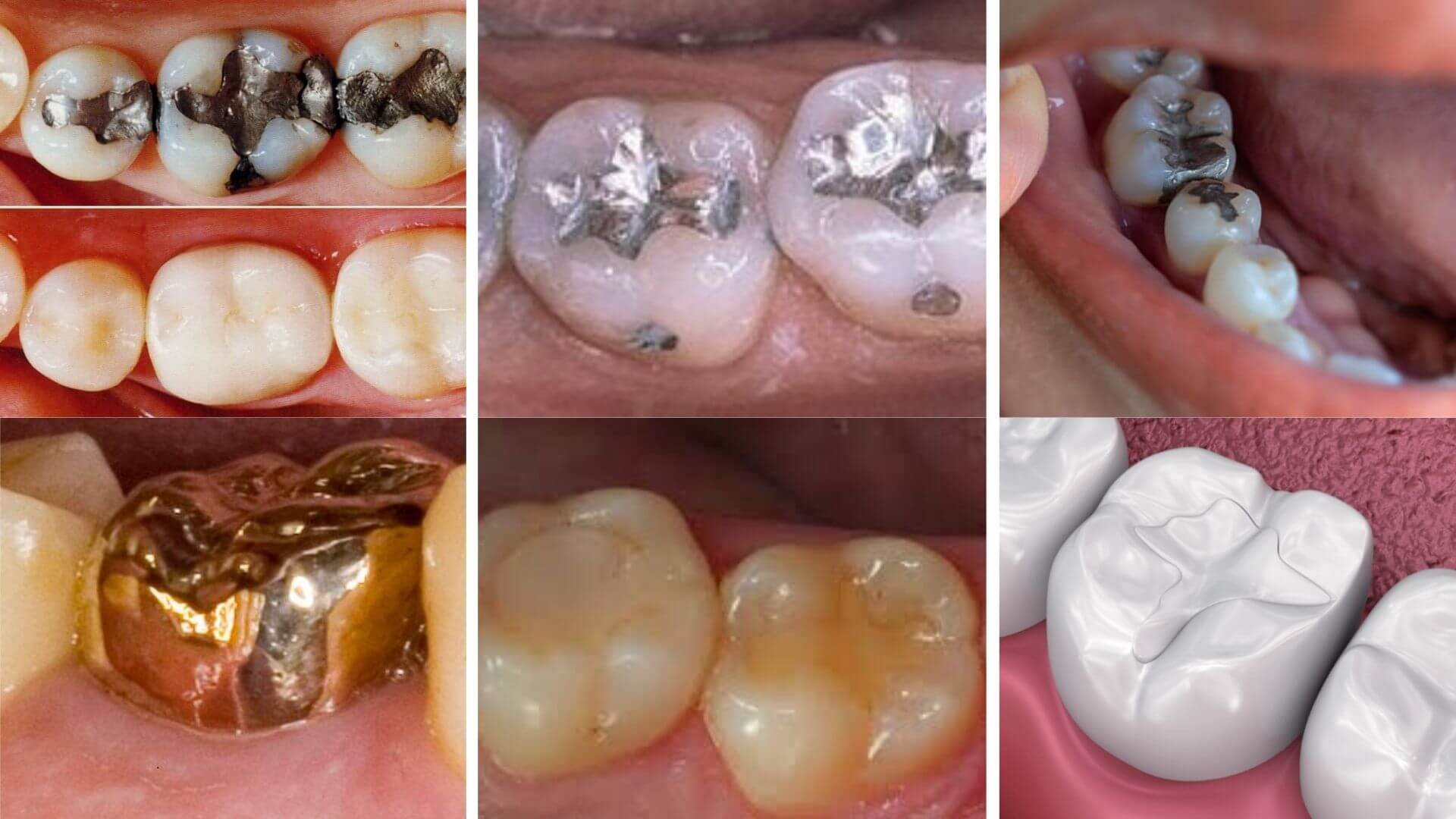 Different Types of Dental Fillings