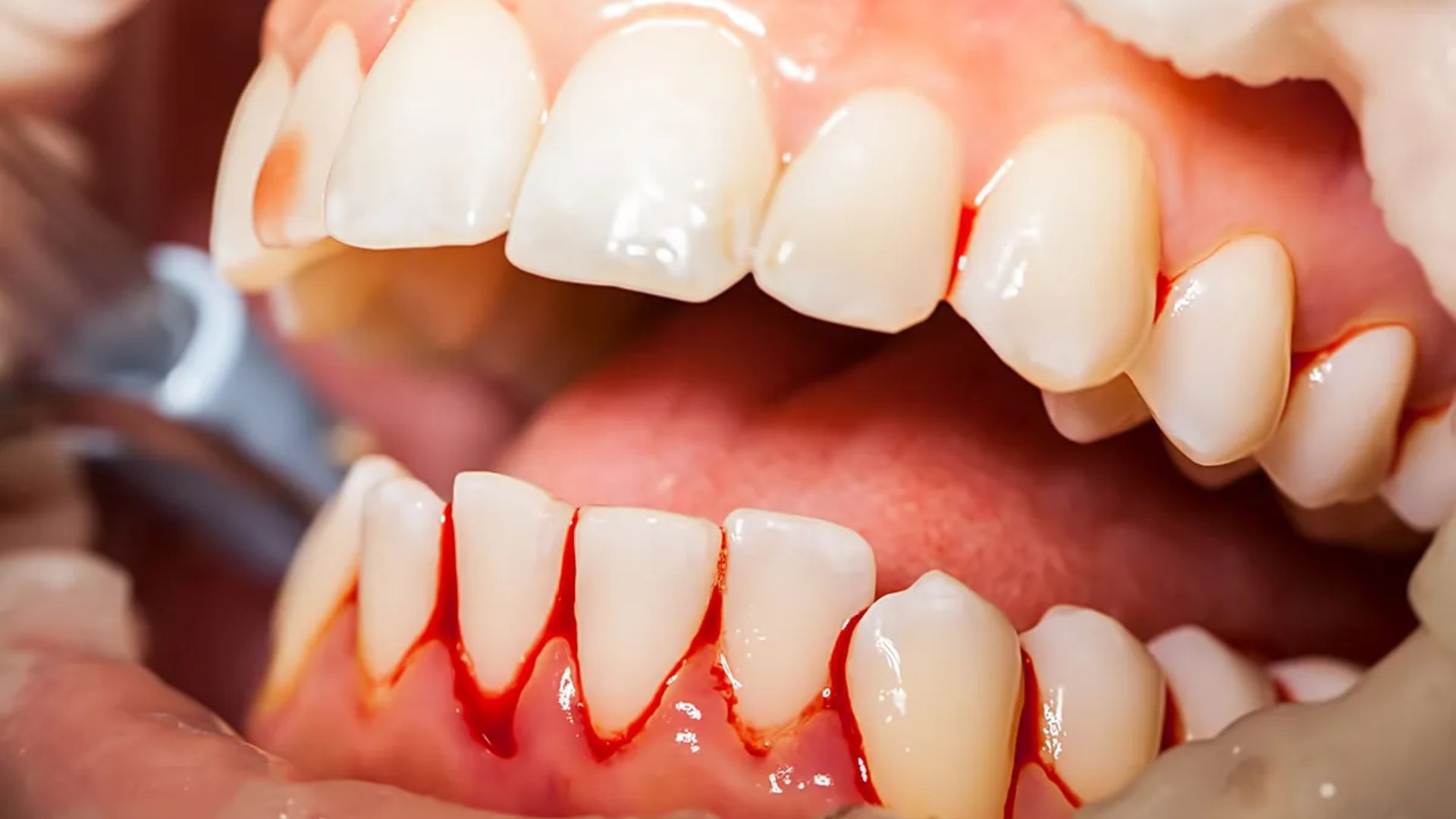 If Your Gums Bleed, You Should Stop Brushing