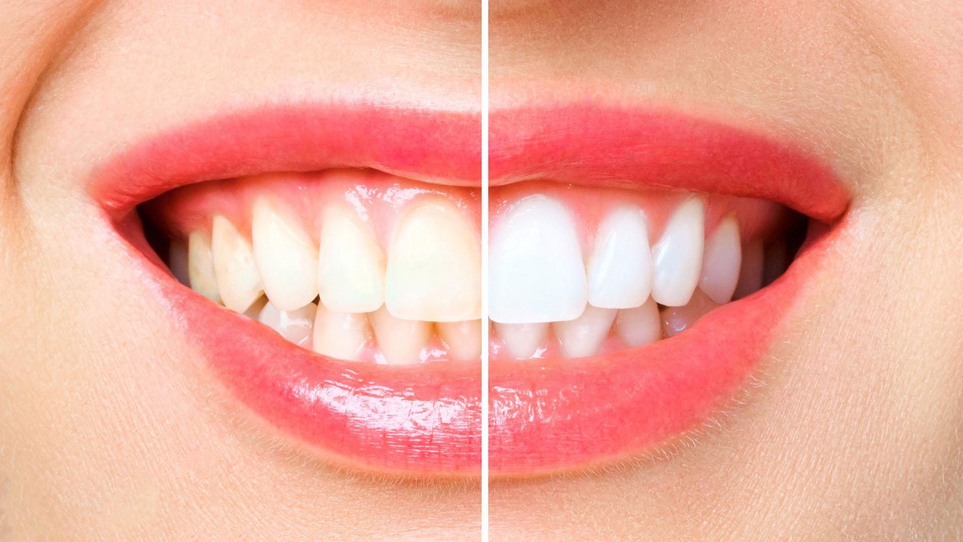 Whitening Damages Your Teeth