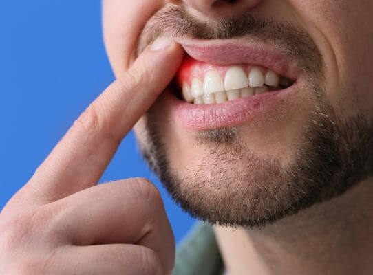 Gum Infection (Gingivitis or Periodontitis)