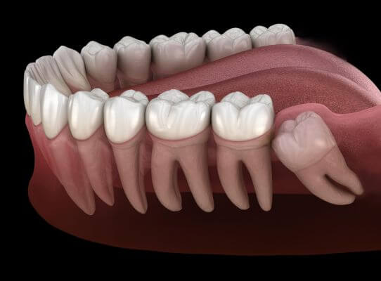 Impacted Wisdom Teeth