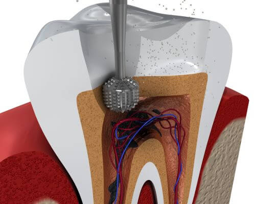 Tooth Abscess (Infection in the Root)