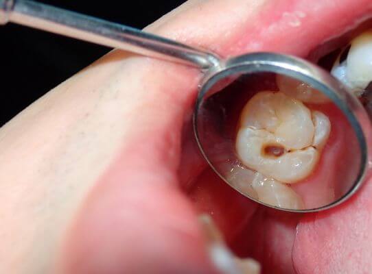 Tooth Decay (Cavities)