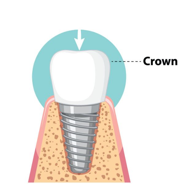 dental implant surgery Crown Placement