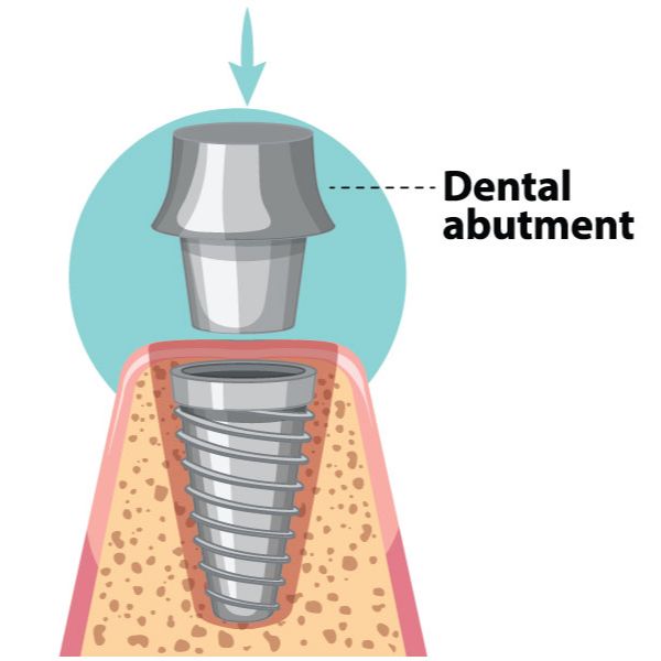 dental implant surgery Abutment Placement