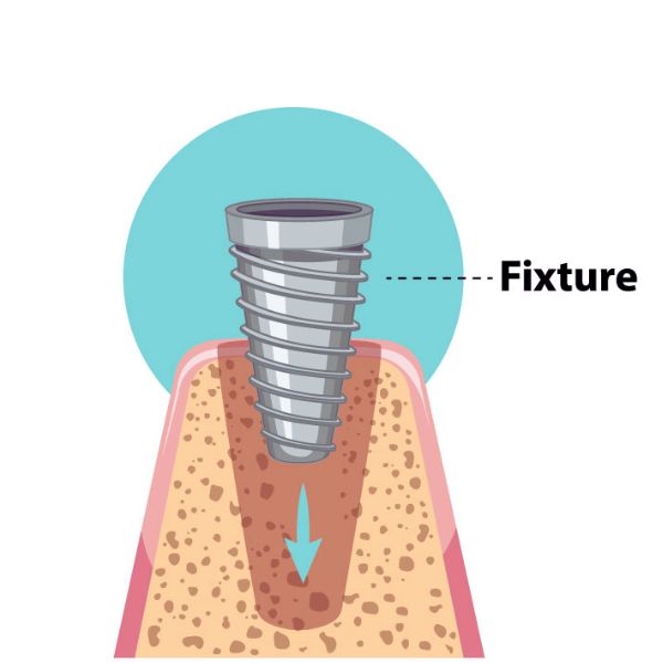 dental implant surgery Placement