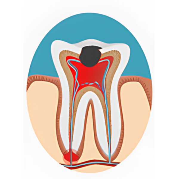 Root Canal - Implant Tooth and Abscess