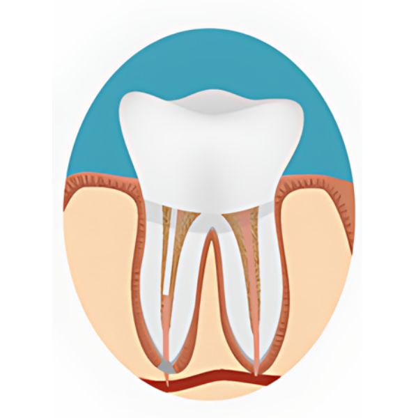 Root Canal - Permanent Filling or Crown Replaced