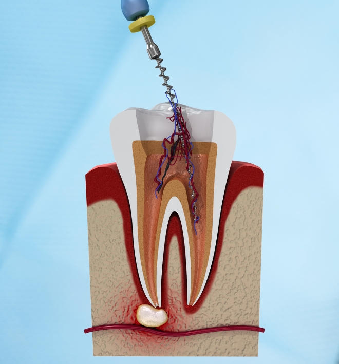 Root canal by Dr. Smruti Nanda Mahapatra - Best Dentist in Bhubaneswar