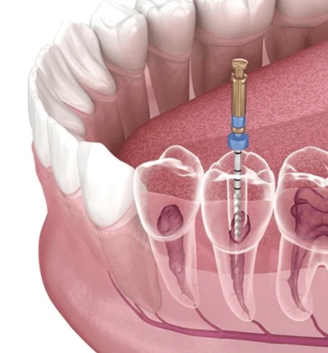 Best Root Canal in Bhubaneswar