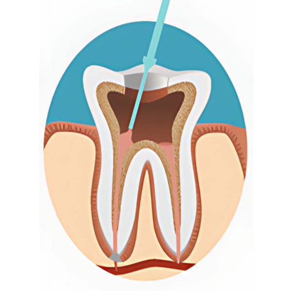 Root Canal - Root Filling Replaced