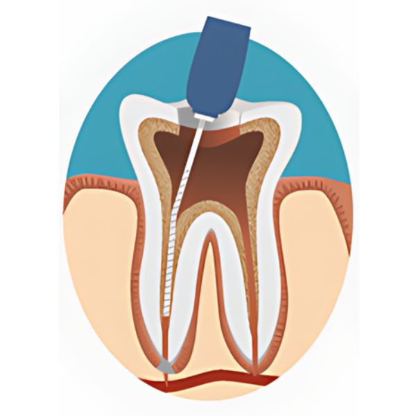 Root Canal - Tooth Cleaned and Shaped